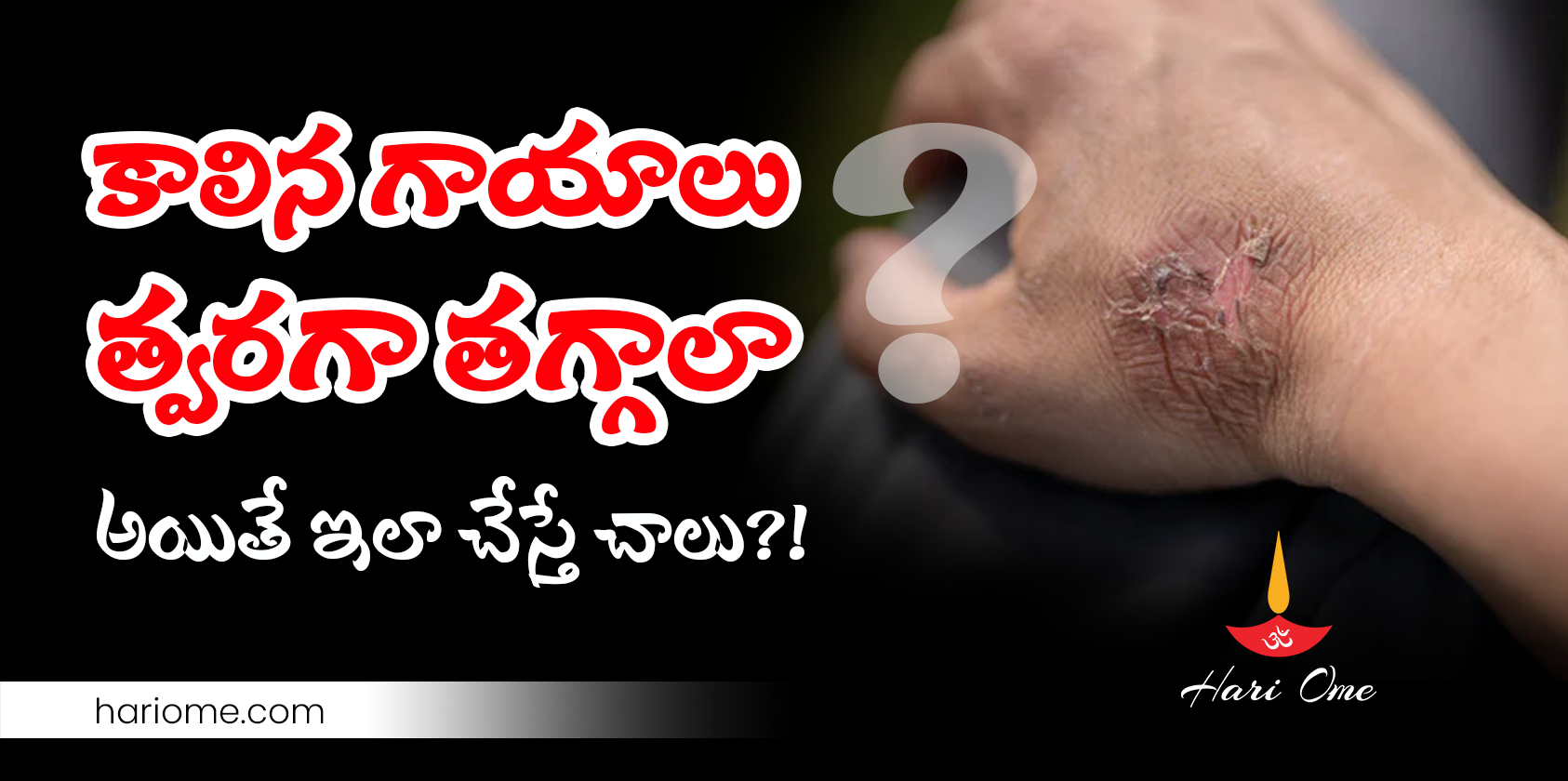 Home remedies for burn injuries
