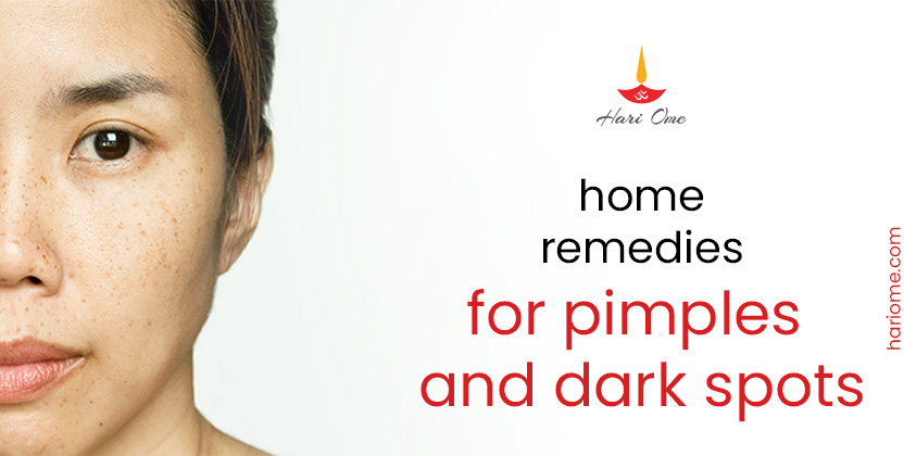 Natural Remedies To Get Rid Of Dark Spots And Pimples